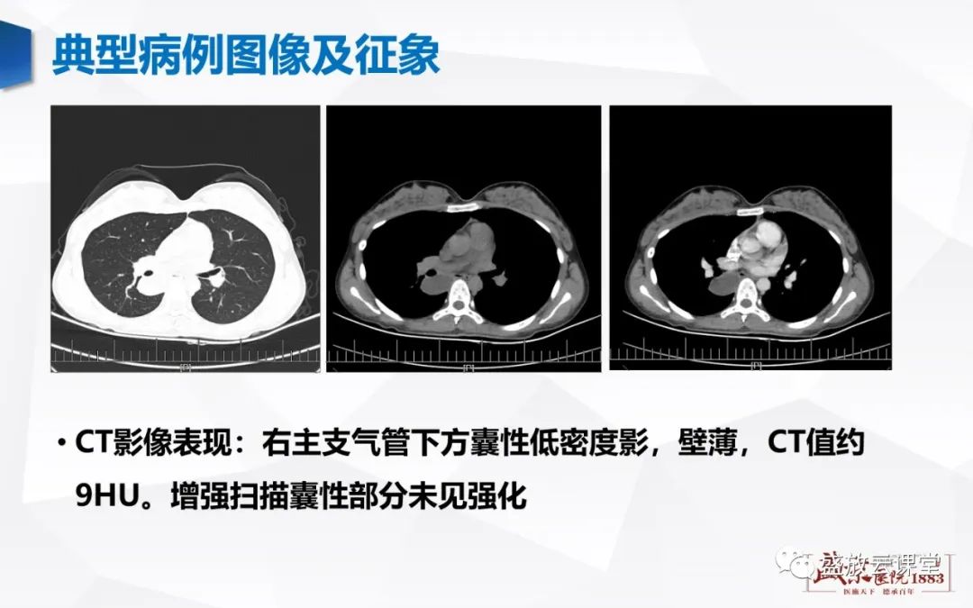 影像PPT - 【PPT】支气管病变-22