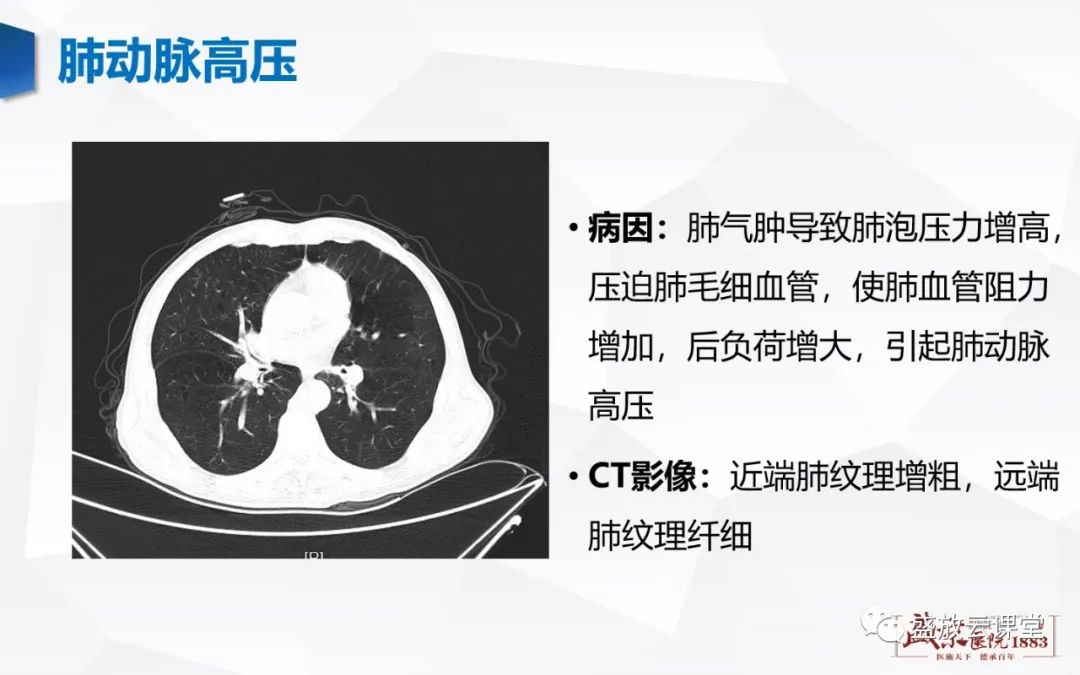 影像PPT - 【PPT】支气管病变-20