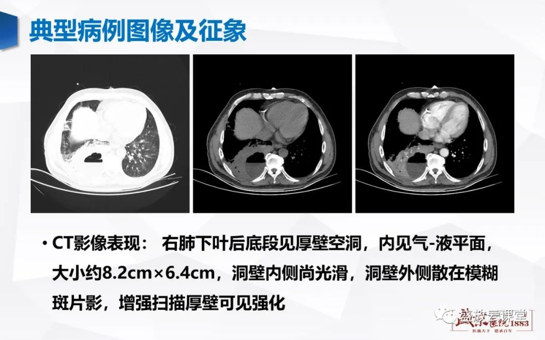 影像PPT - 【PPT】支气管病变-25