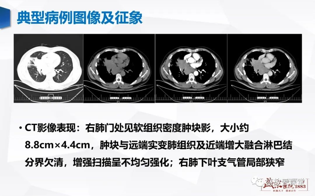 影像PPT - 【PPT】支气管病变-27