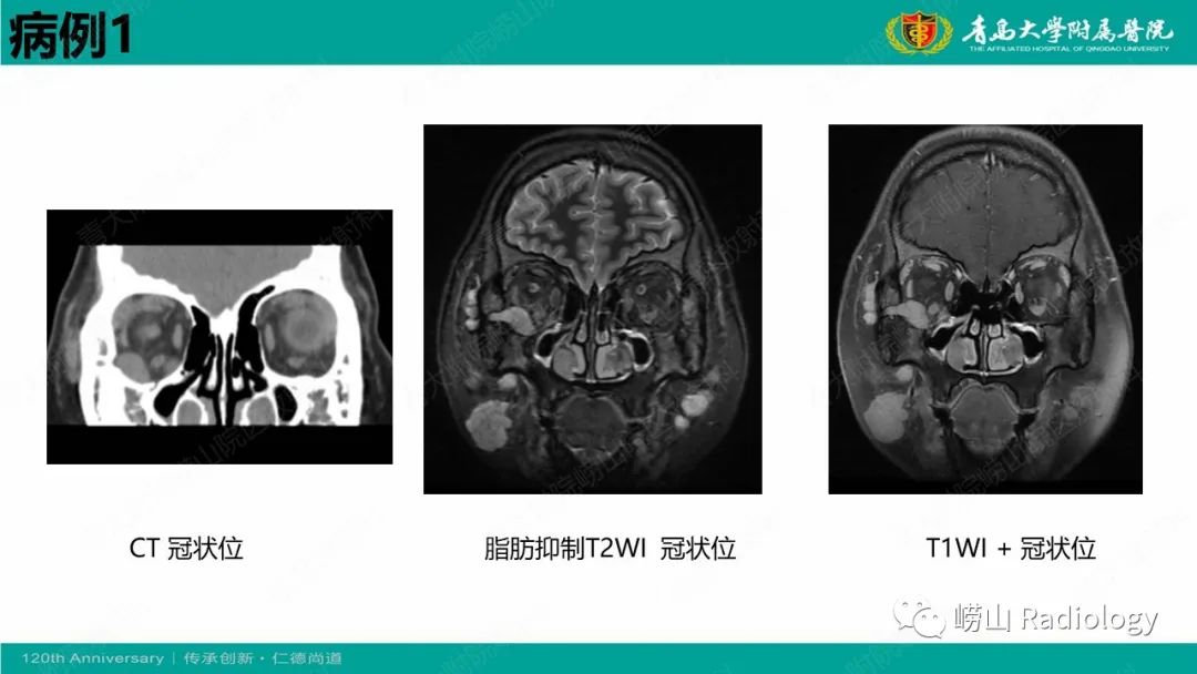 影像PPT - 【病例】Rosai-Dorfman病 & 套细胞淋巴瘤-6