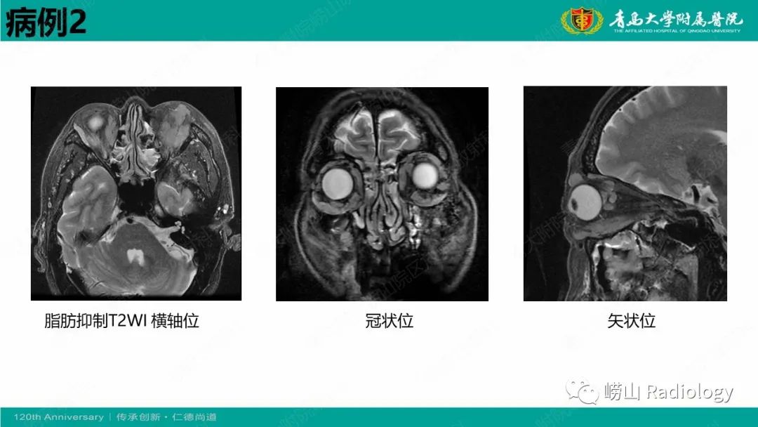 影像PPT - 【病例】Rosai-Dorfman病 & 套细胞淋巴瘤-9