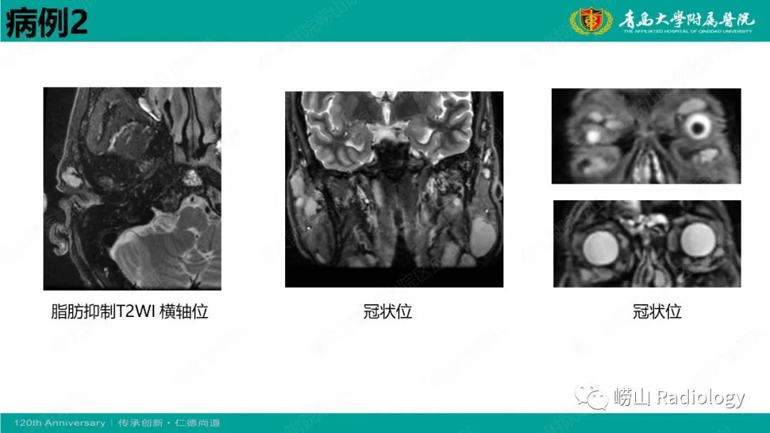 影像PPT - 【病例】Rosai-Dorfman病 & 套细胞淋巴瘤-11