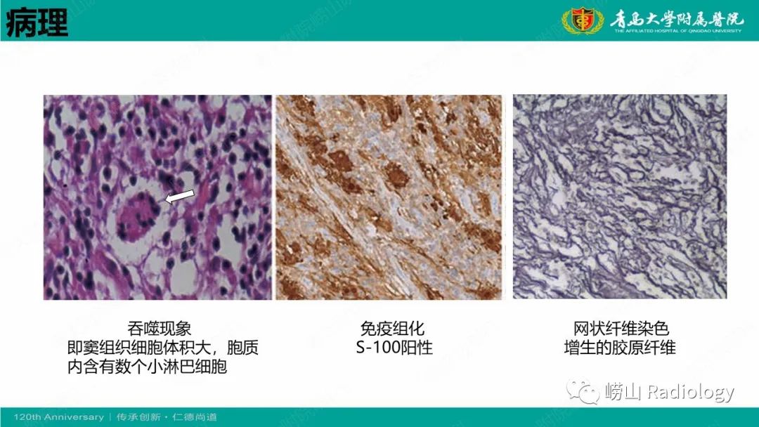 影像PPT - 【病例】Rosai-Dorfman病 & 套细胞淋巴瘤-16