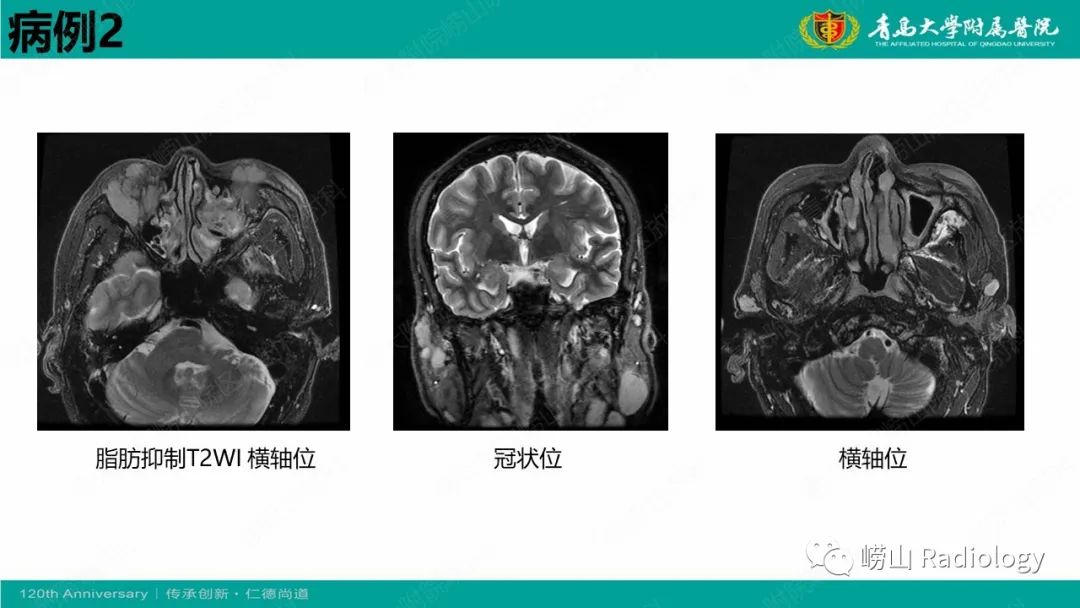 影像PPT - 【病例】Rosai-Dorfman病 & 套细胞淋巴瘤-13