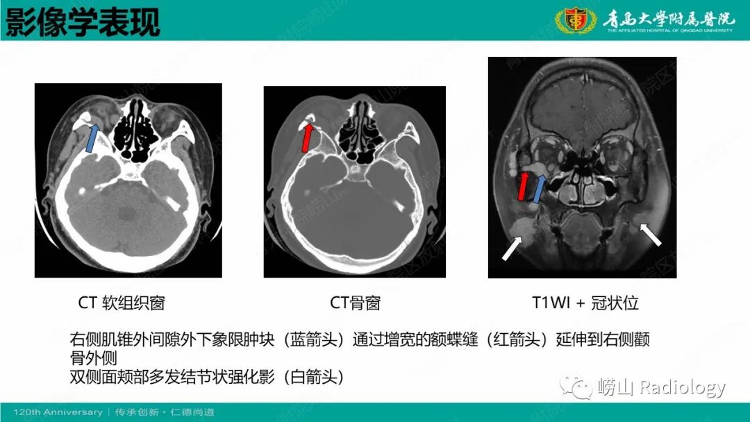 影像PPT - 【病例】Rosai-Dorfman病 & 套细胞淋巴瘤-22