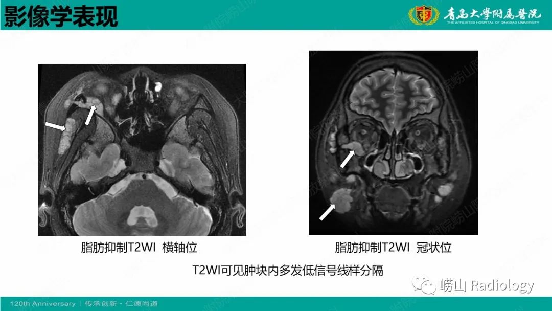 影像PPT - 【病例】Rosai-Dorfman病 & 套细胞淋巴瘤-23
