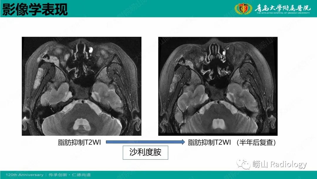 影像PPT - 【病例】Rosai-Dorfman病 & 套细胞淋巴瘤-24