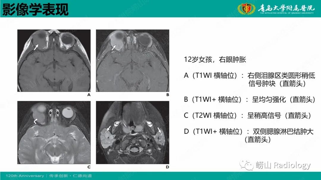 影像PPT - 【病例】Rosai-Dorfman病 & 套细胞淋巴瘤-25
