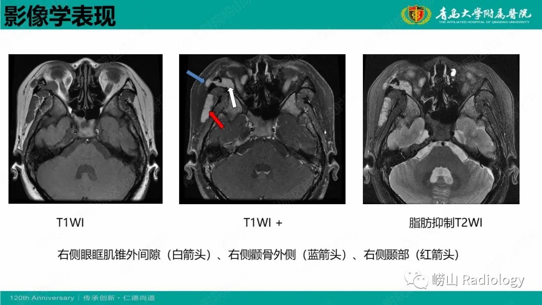 影像PPT - 【病例】Rosai-Dorfman病 & 套细胞淋巴瘤-21