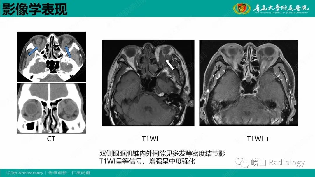 影像PPT - 【病例】Rosai-Dorfman病 & 套细胞淋巴瘤-33