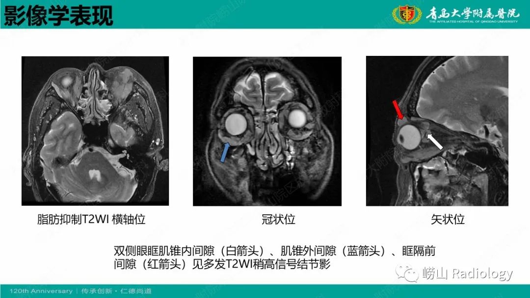 影像PPT - 【病例】Rosai-Dorfman病 & 套细胞淋巴瘤-34