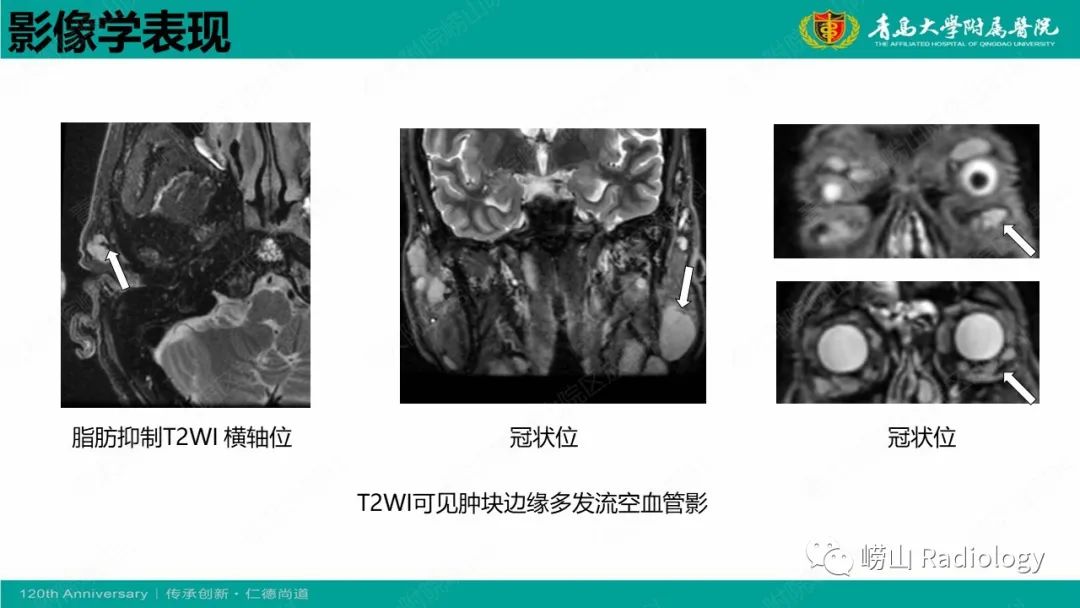影像PPT - 【病例】Rosai-Dorfman病 & 套细胞淋巴瘤-35