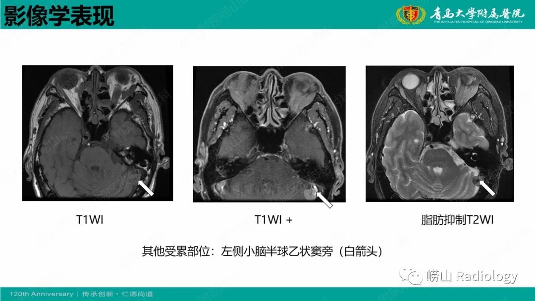 影像PPT - 【病例】Rosai-Dorfman病 & 套细胞淋巴瘤-36