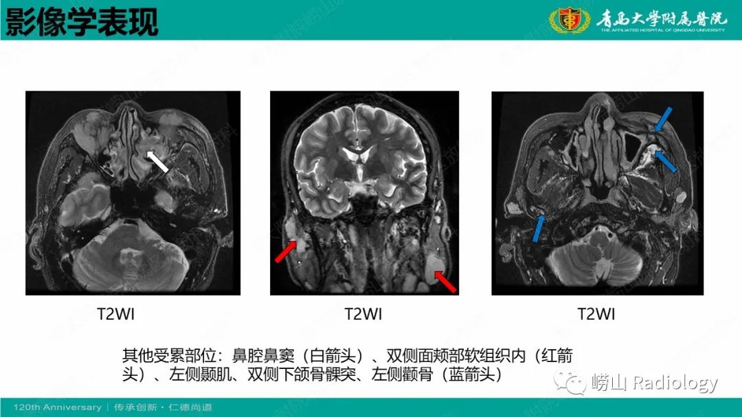 影像PPT - 【病例】Rosai-Dorfman病 & 套细胞淋巴瘤-37
