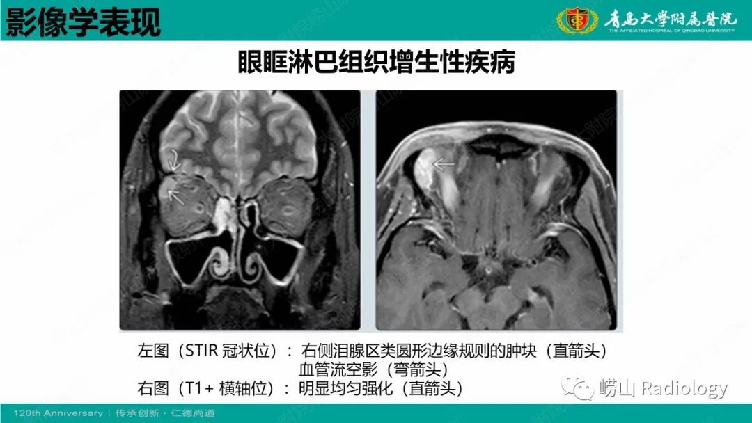 影像PPT - 【病例】Rosai-Dorfman病 & 套细胞淋巴瘤-38