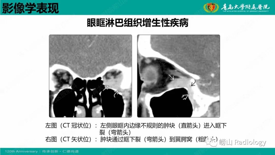 影像PPT - 【病例】Rosai-Dorfman病 & 套细胞淋巴瘤-39