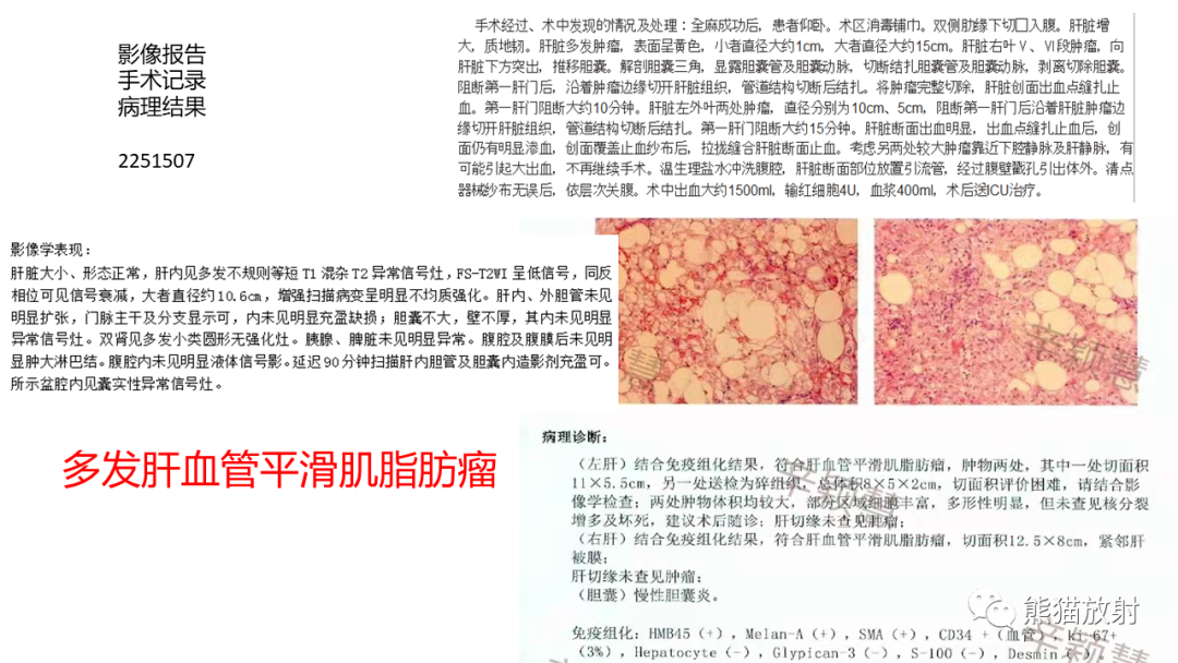 影像PPT - 【病例】肝血管平滑肌脂肪瘤 VS 含脂肝细胞肝癌-30