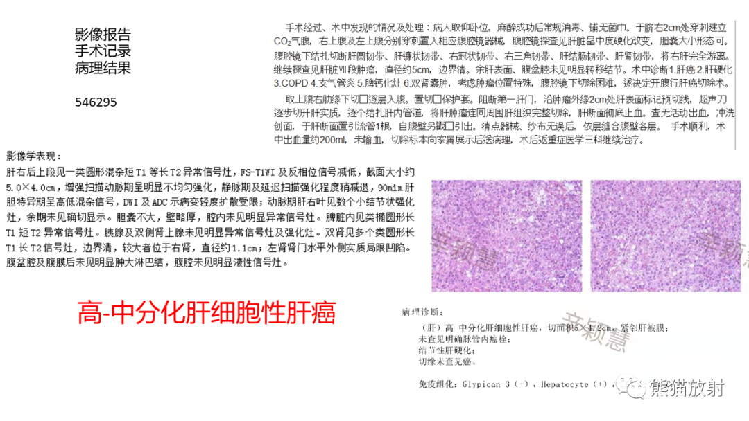 影像PPT - 【病例】肝血管平滑肌脂肪瘤 VS 含脂肝细胞肝癌-31
