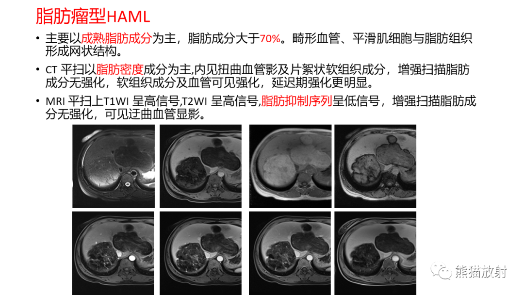 影像PPT - 【病例】肝血管平滑肌脂肪瘤 VS 含脂肝细胞肝癌-37
