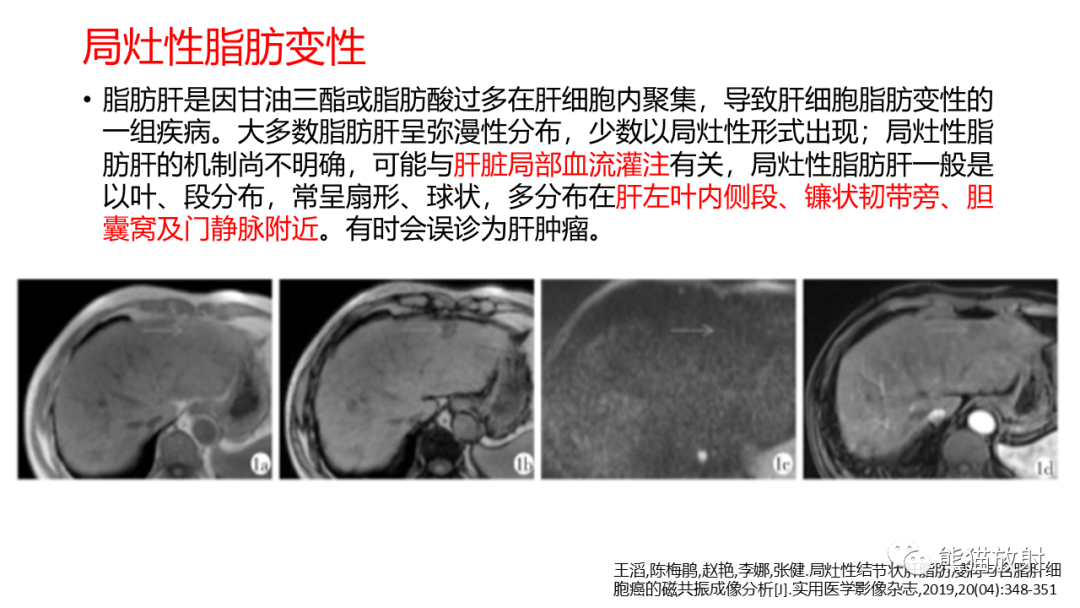 影像PPT - 【病例】肝血管平滑肌脂肪瘤 VS 含脂肝细胞肝癌-40