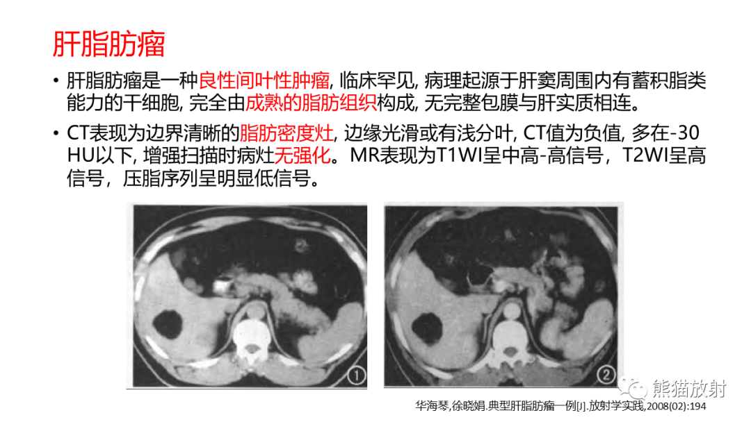 影像PPT - 【病例】肝血管平滑肌脂肪瘤 VS 含脂肝细胞肝癌-39