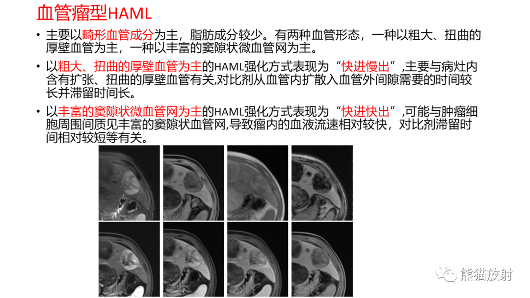 影像PPT - 【病例】肝血管平滑肌脂肪瘤 VS 含脂肝细胞肝癌-35