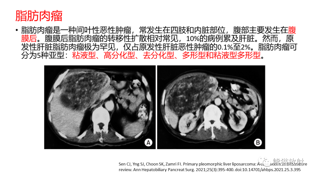影像PPT - 【病例】肝血管平滑肌脂肪瘤 VS 含脂肝细胞肝癌-45