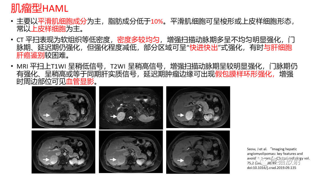 影像PPT - 【病例】肝血管平滑肌脂肪瘤 VS 含脂肝细胞肝癌-3