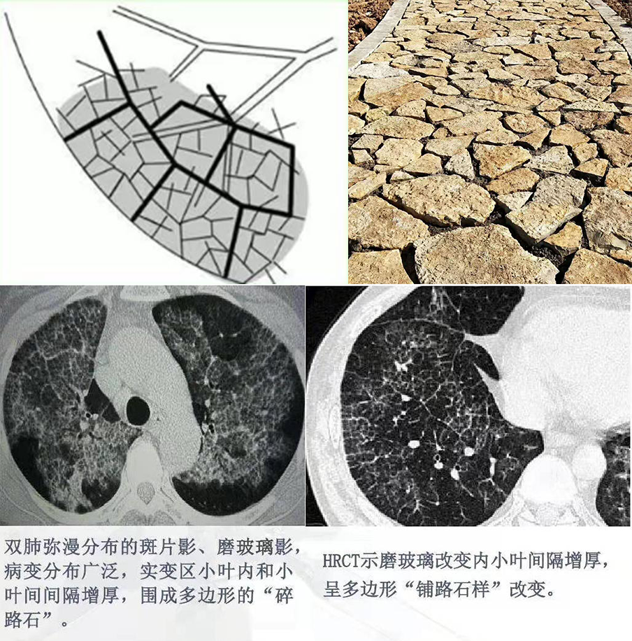 影像PPT - 【病例】肺泡蛋白沉积症3例典型CT影像-7 影像PPT - 【病例】肺泡蛋白沉积症3例典型CT影像-7