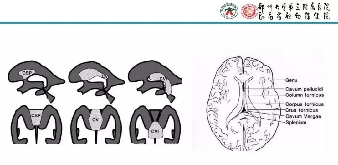 影像PPT - 【PPT】透明隔腔的影像表现及临床意义-7