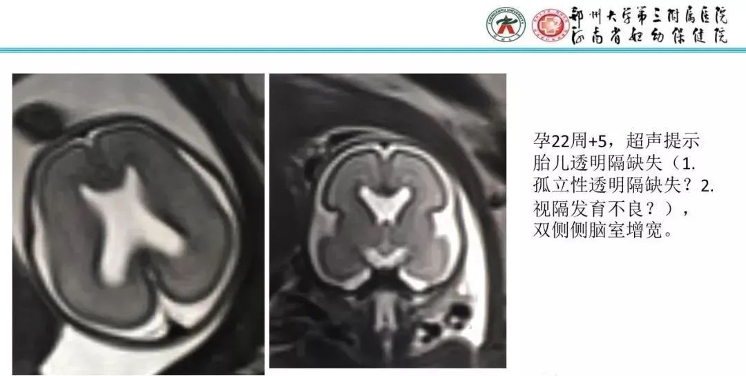 影像PPT - 【PPT】透明隔腔的影像表现及临床意义-11