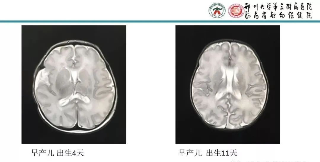 影像PPT - 【PPT】透明隔腔的影像表现及临床意义-15