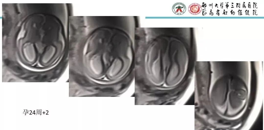 影像PPT - 【PPT】透明隔腔的影像表现及临床意义-14