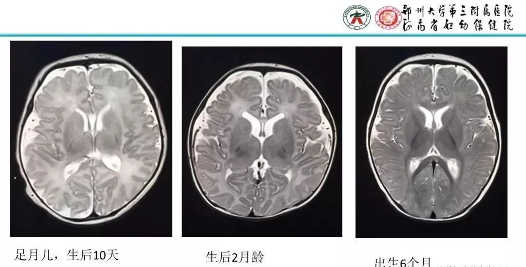 影像PPT - 【PPT】透明隔腔的影像表现及临床意义-16