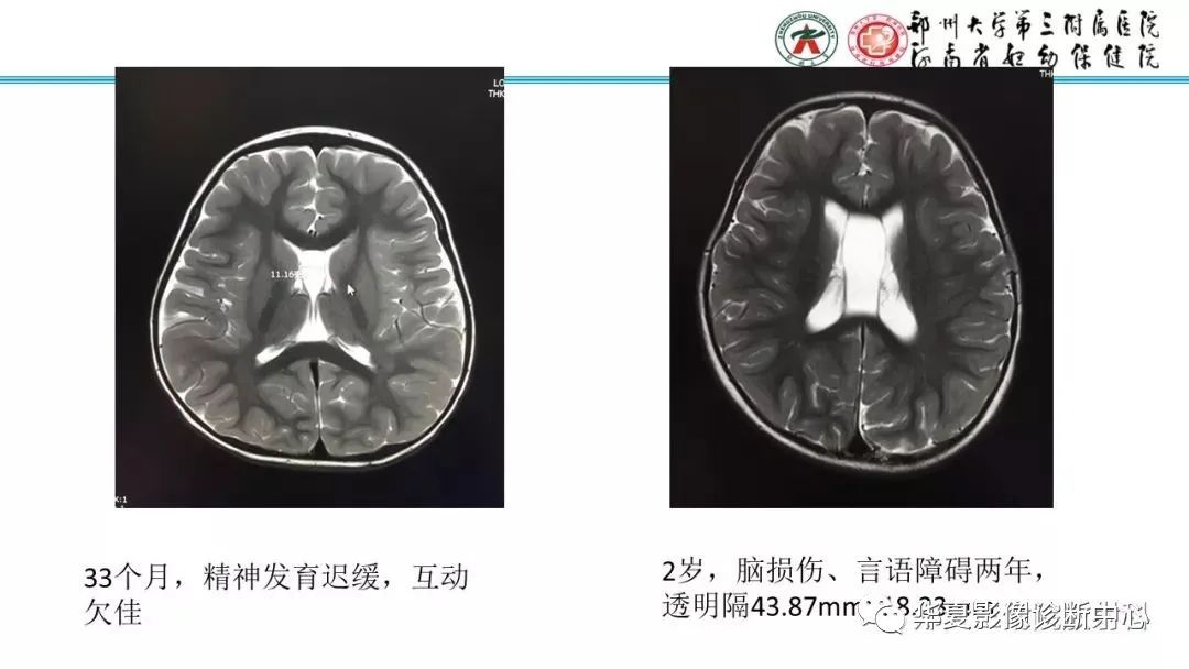影像PPT - 【PPT】透明隔腔的影像表现及临床意义-21