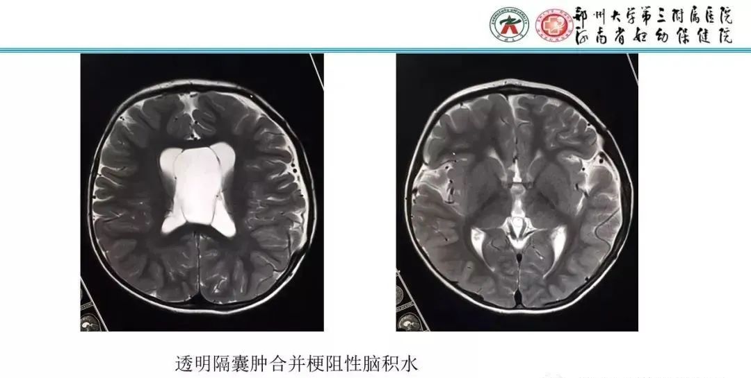 影像PPT - 【PPT】透明隔腔的影像表现及临床意义-23