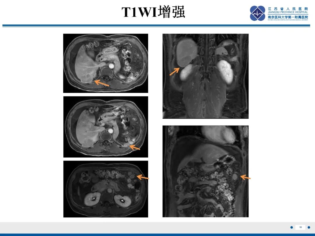 影像PPT - 【PPT】卵巢甲状腺肿合并畸胎瘤-11