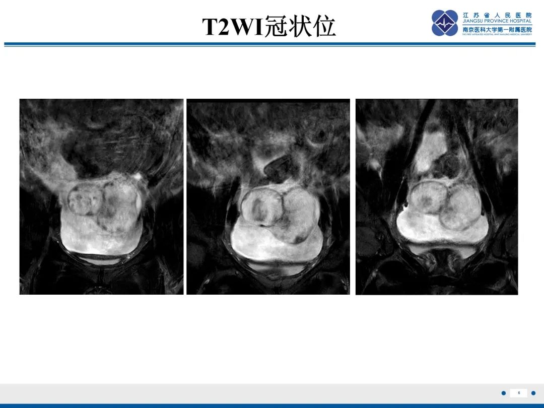 影像PPT - 【PPT】卵巢甲状腺肿合并畸胎瘤-7
