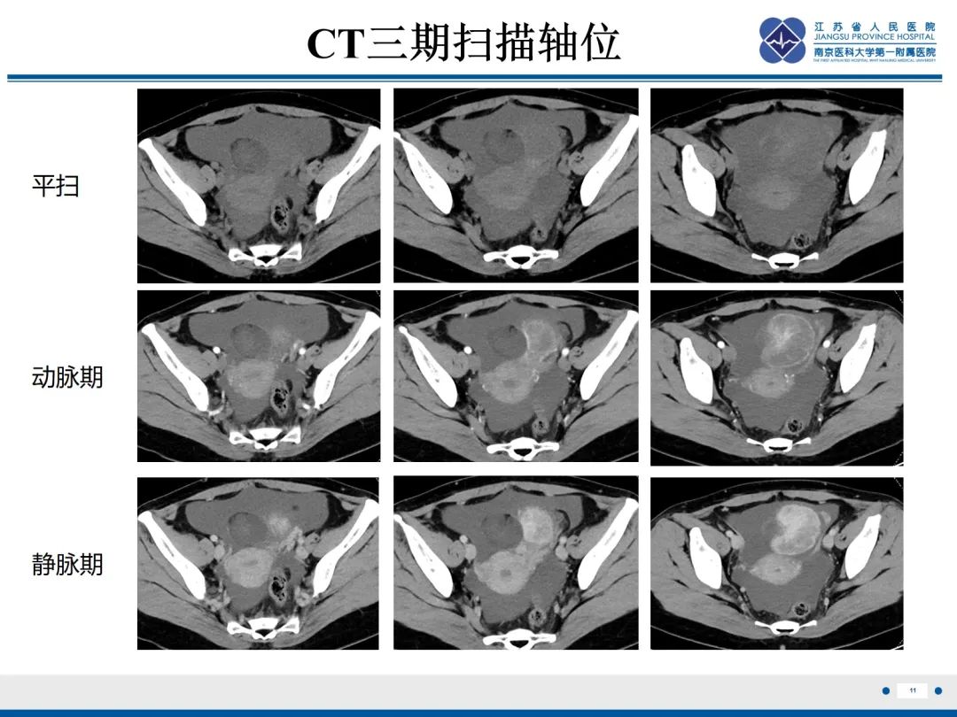 影像PPT - 【PPT】卵巢甲状腺肿合并畸胎瘤-12