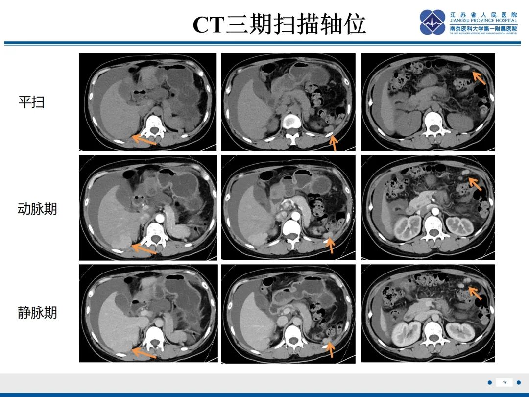 影像PPT - 【PPT】卵巢甲状腺肿合并畸胎瘤-13