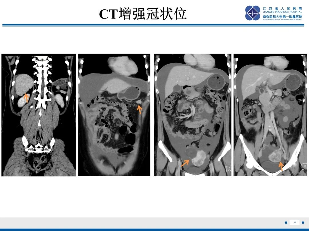 影像PPT - 【PPT】卵巢甲状腺肿合并畸胎瘤-14