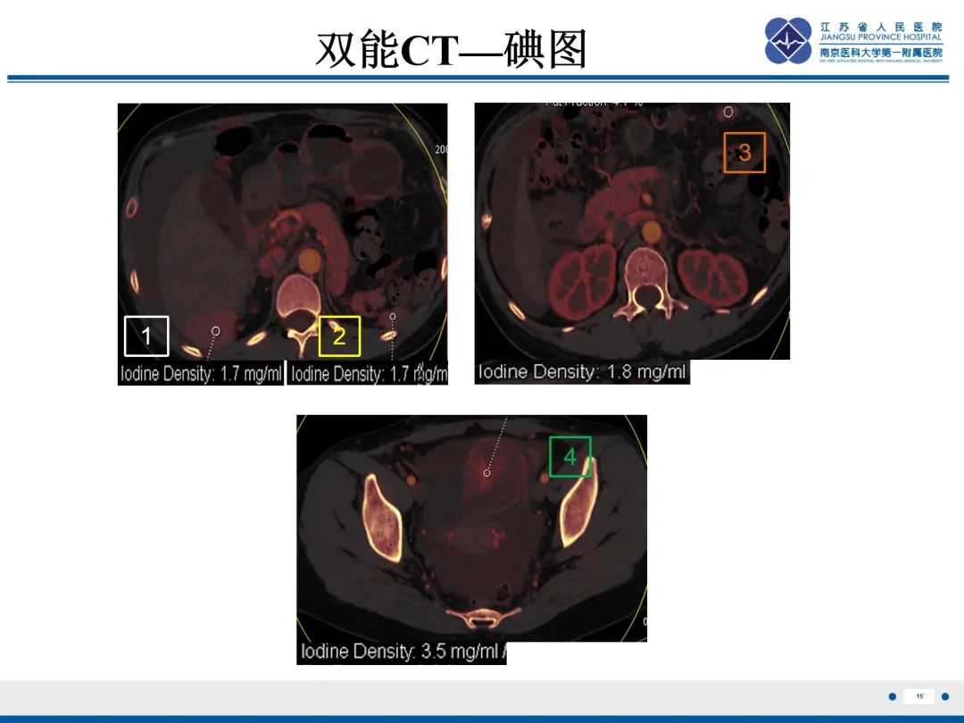 影像PPT - 【PPT】卵巢甲状腺肿合并畸胎瘤-16