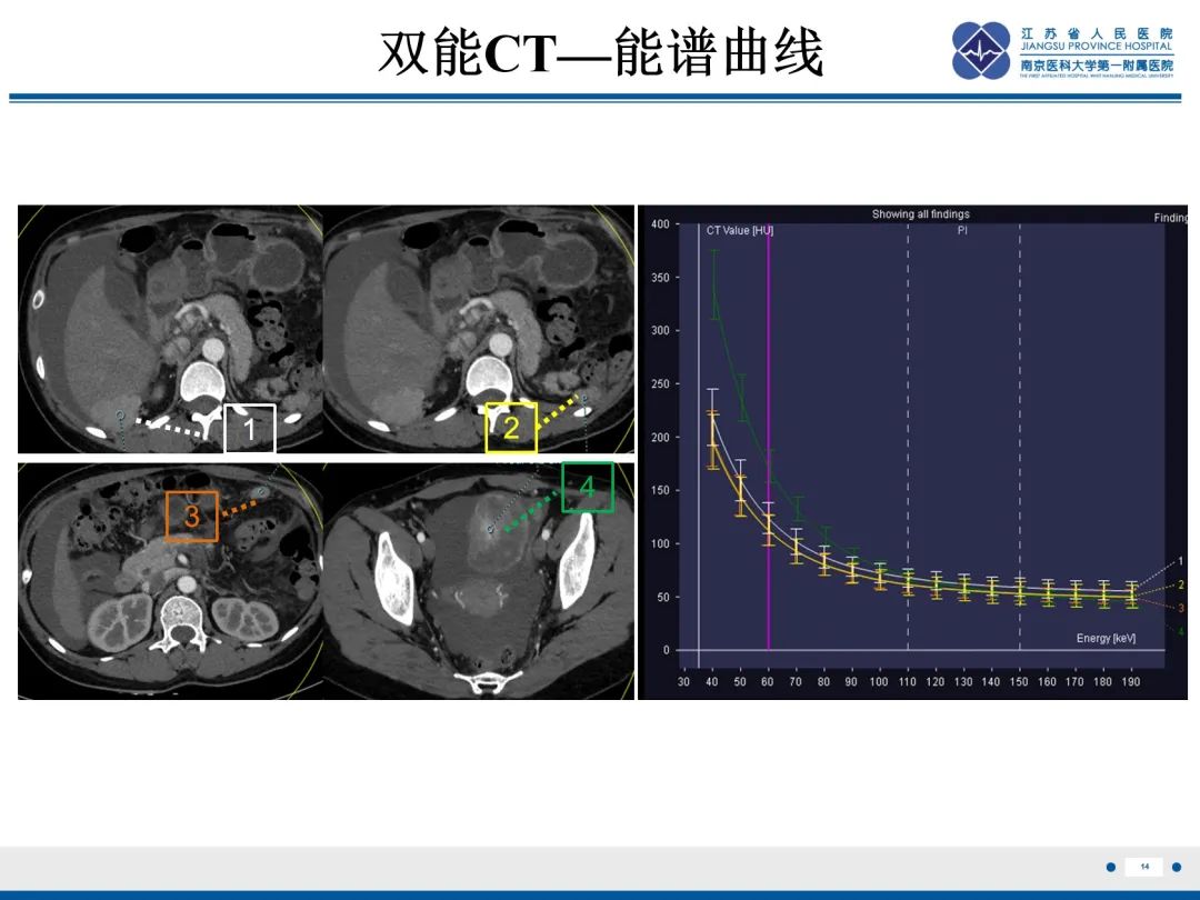 影像PPT - 【PPT】卵巢甲状腺肿合并畸胎瘤-15