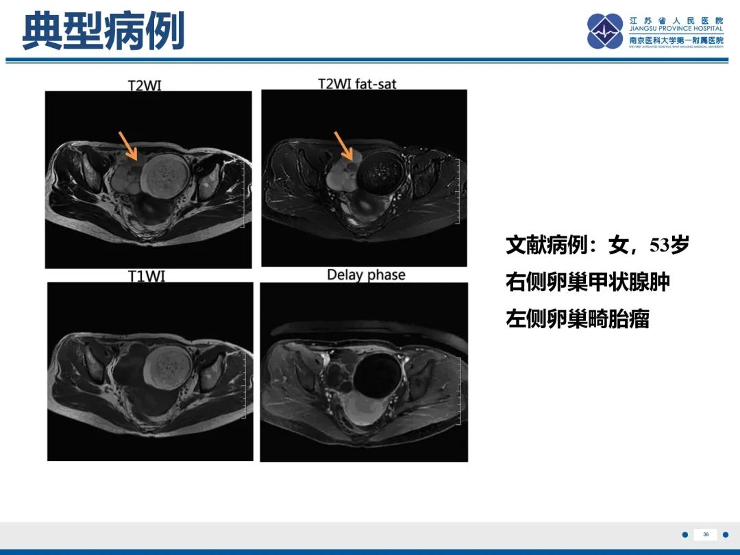 影像PPT - 【PPT】卵巢甲状腺肿合并畸胎瘤-37