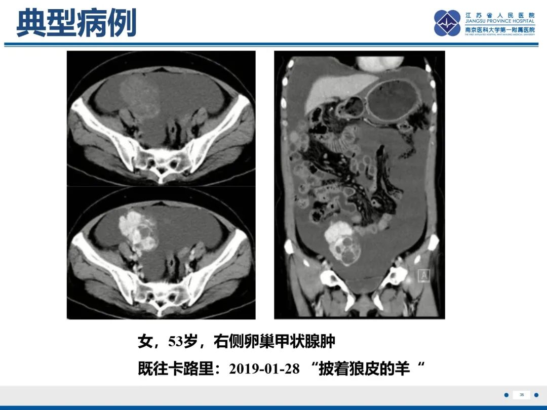 影像PPT - 【PPT】卵巢甲状腺肿合并畸胎瘤-36