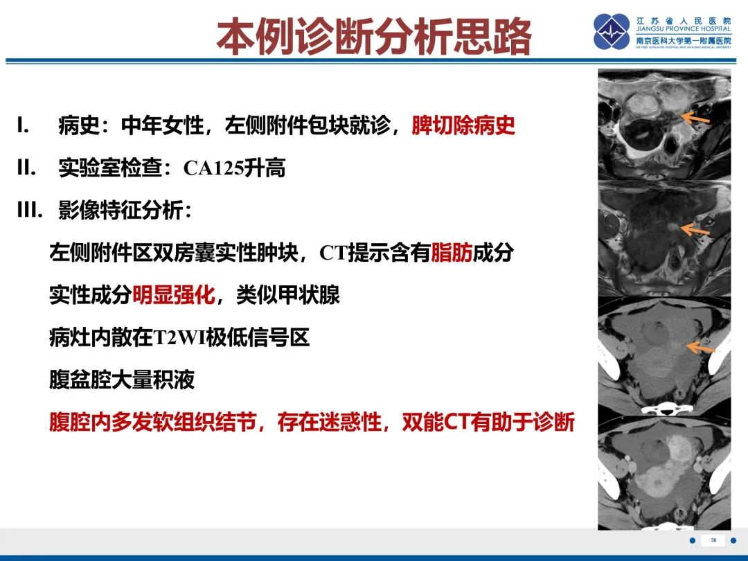 影像PPT - 【PPT】卵巢甲状腺肿合并畸胎瘤-39