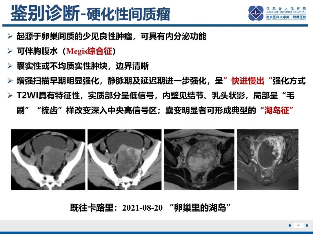 影像PPT - 【PPT】卵巢甲状腺肿合并畸胎瘤-42