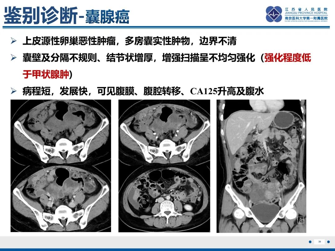 影像PPT - 【PPT】卵巢甲状腺肿合并畸胎瘤-40