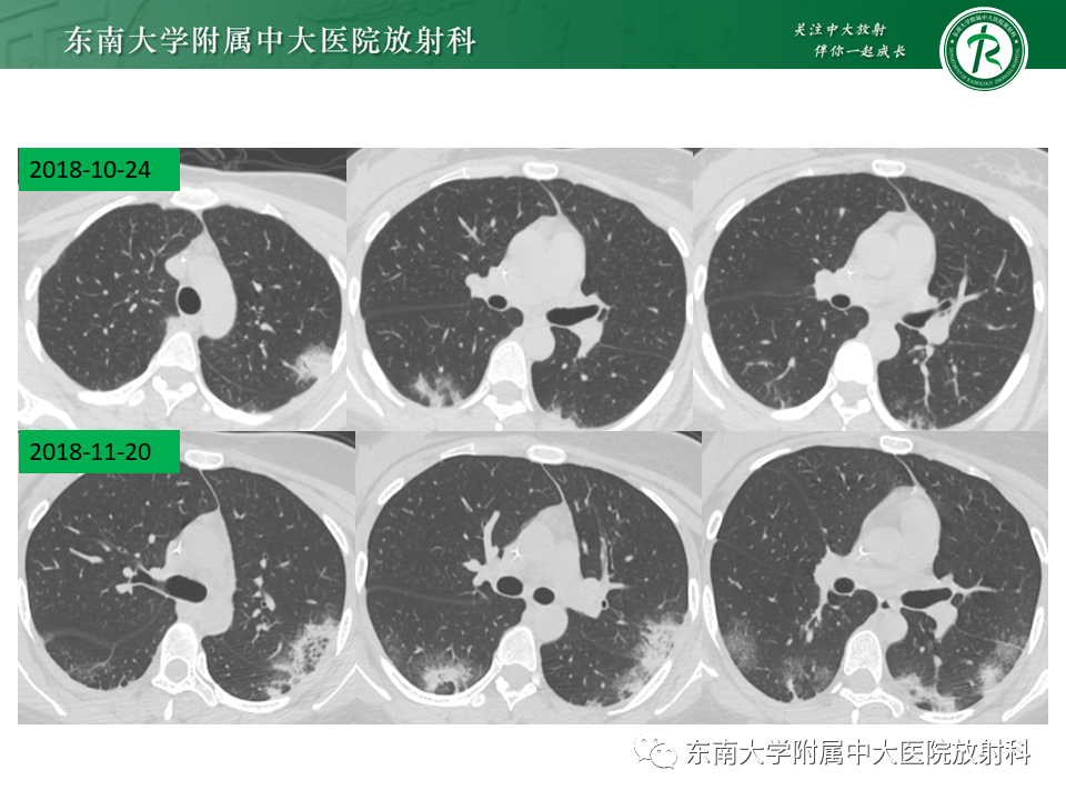 影像PPT - 【PPT】“反晕征”相关病变及鉴别-2